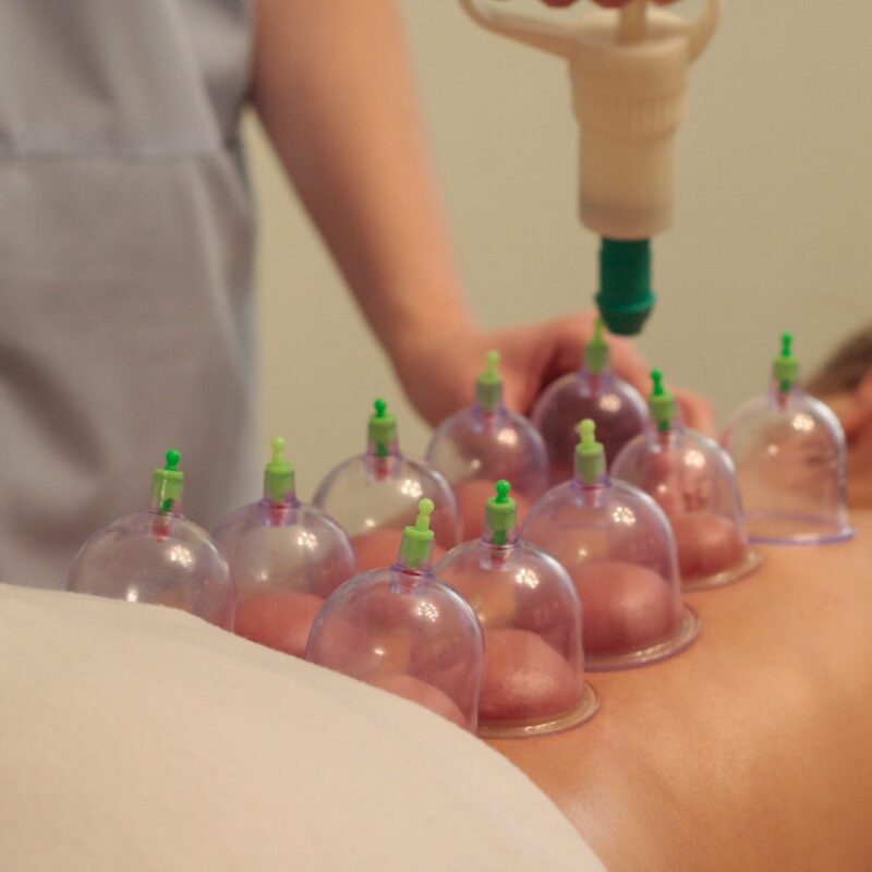 Hijama behandeling Hernia